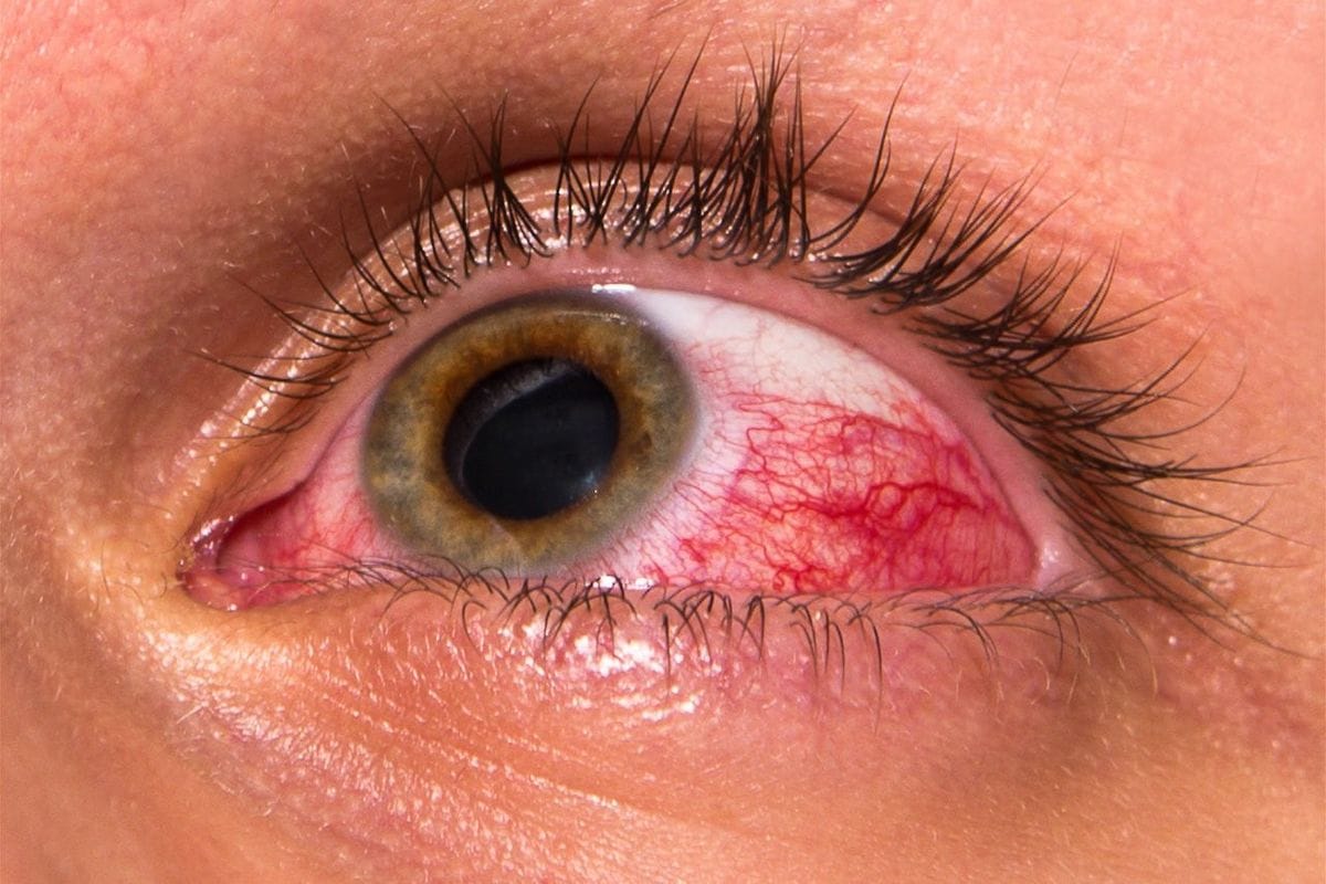 Metagenomics solves uveitis mystery