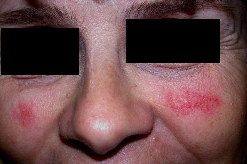 Style Eyes: Allergic to glasses?