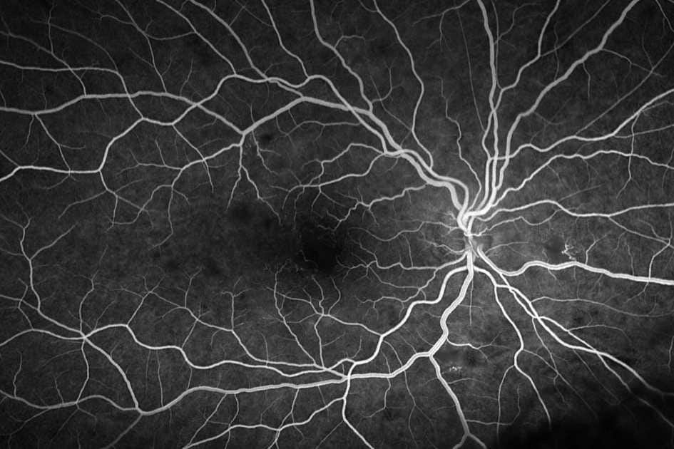 Thrombotic microangiopathy with Purtscher’s-like retinopathy findings