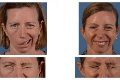 New technique restores blink ability
