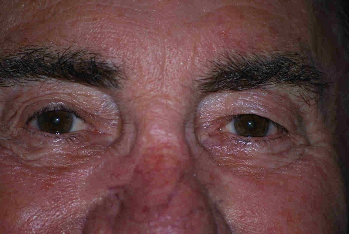 Krill vs fish oil and other eye treatments