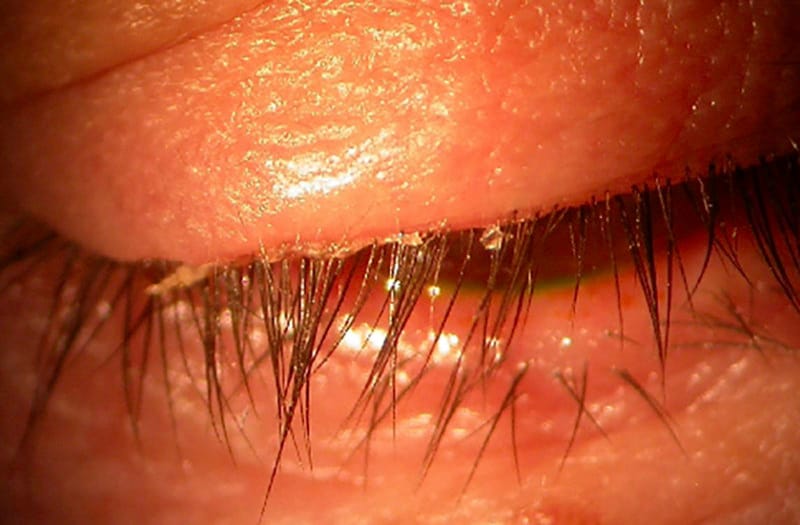 Blepharitis: lid cleaner versus baby shampoo