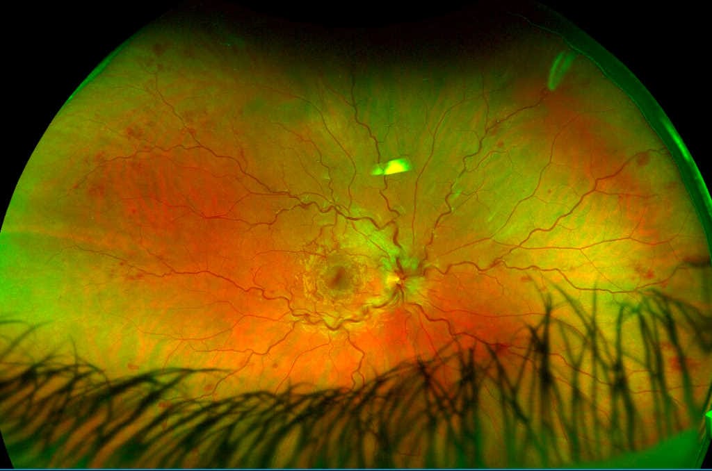 How does Covid-19 affect the eye?