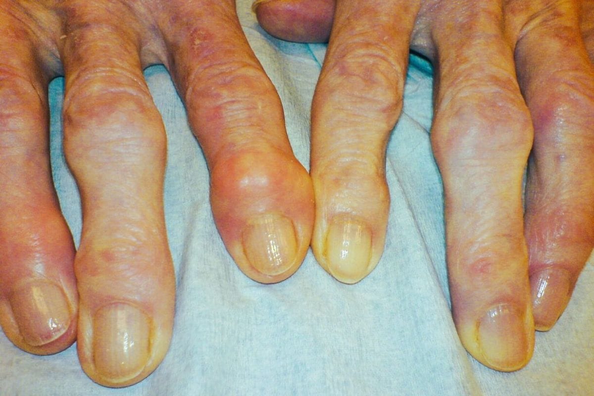 oesteoarthritis