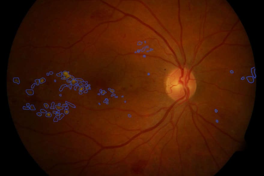 AI picks up early diabetic retinopathy