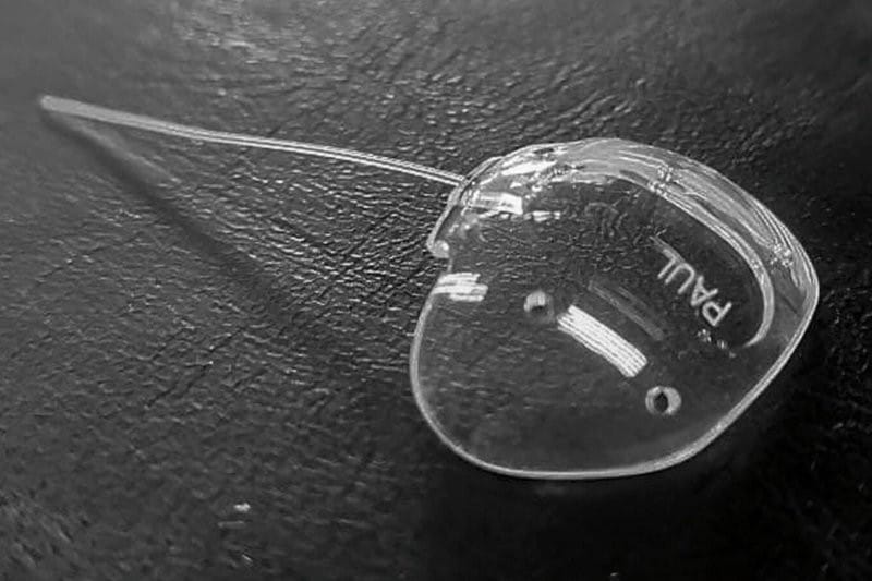 Paul glaucoma implant effective and safe