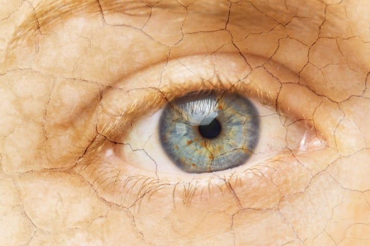 Dry eye and systemic disease
