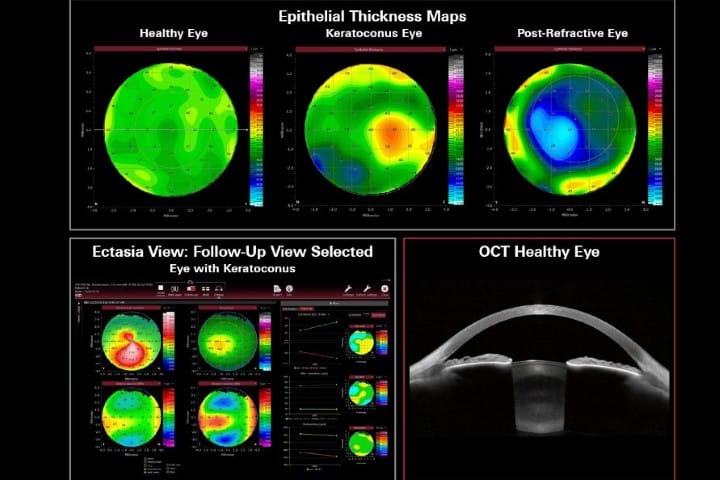 FDA clears Anterion upgrade