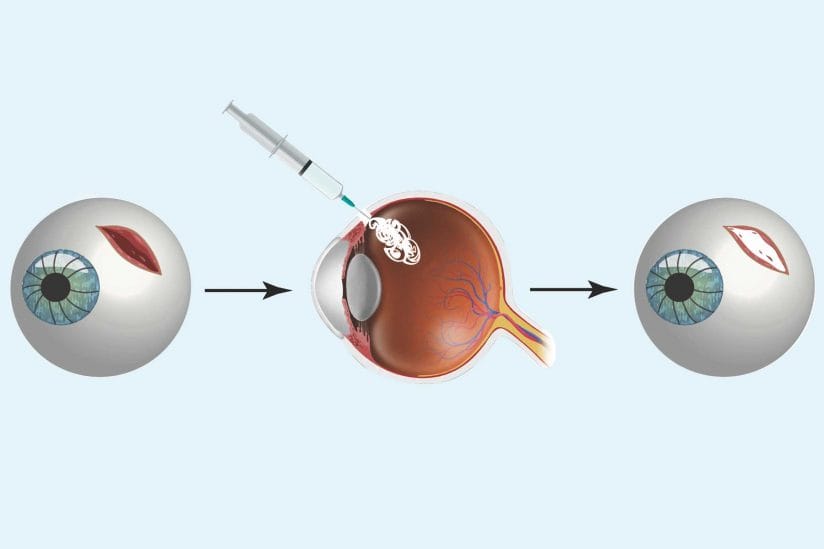 Portable glue for eye emergencies