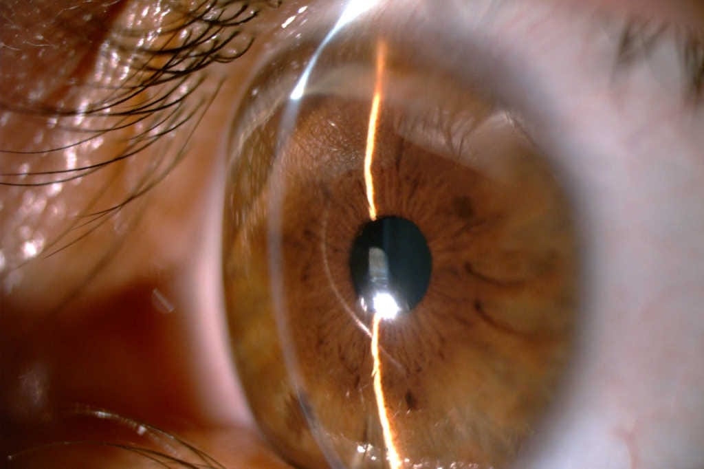 Unravelling the mystery of corneal peripheral thinning disorders