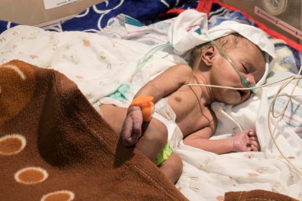 RANZCO backs PNG baby screening