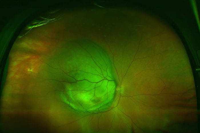 Plant compound shuts down eye tumour growth