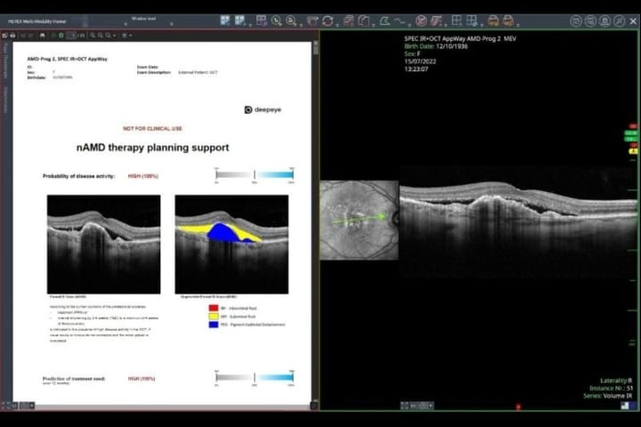 AI boosts nAMD therapy planning