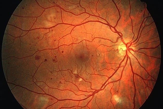 diabetic retinopathy 1
