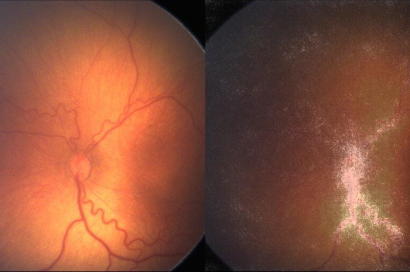 AI effective in ROP screening