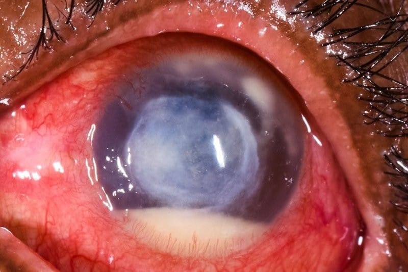 Keratoplasty infections jeopardise grafts