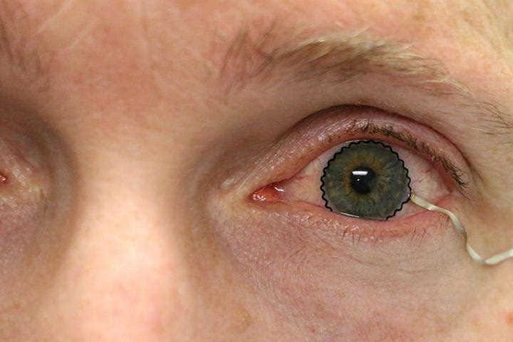 CL-disease monitoring a step closer