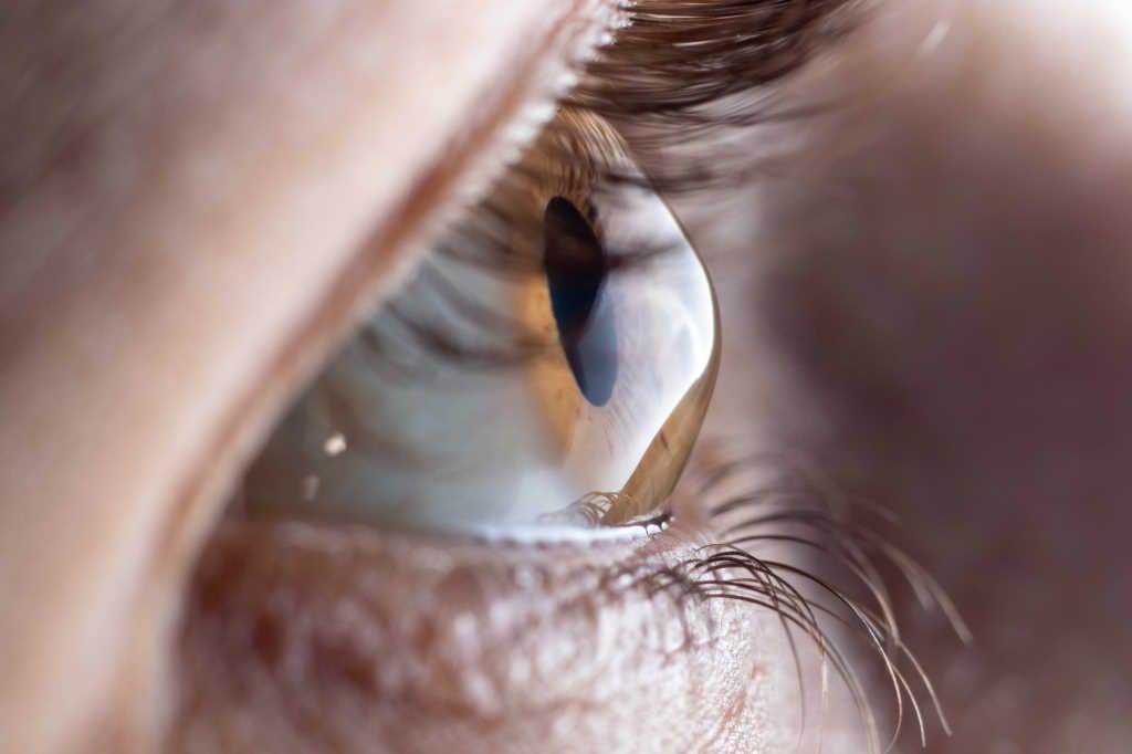 Help battle keratoconus in NZ