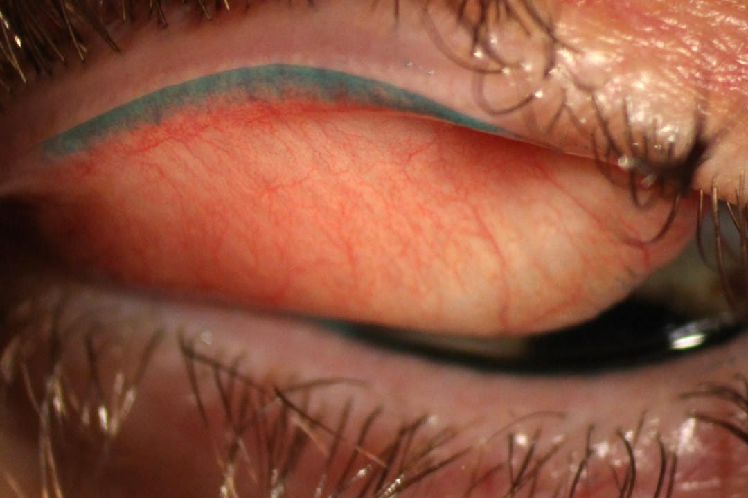 Lid-wiper staining beats corneal staining for detecting DED