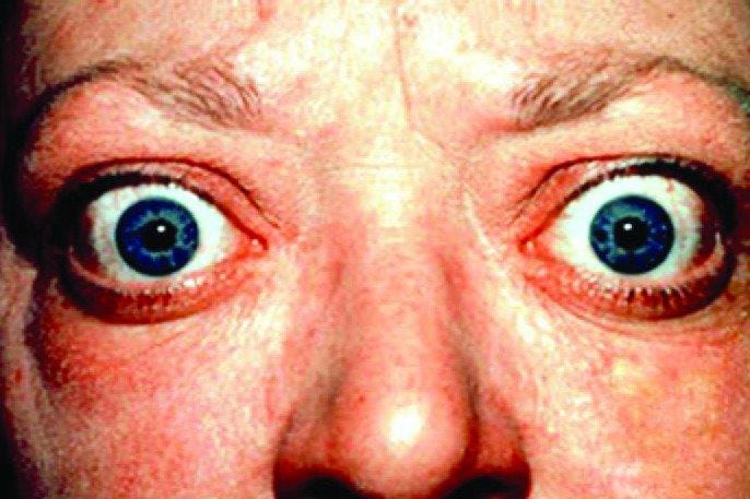 Smartphone exophthalmos evaluation success