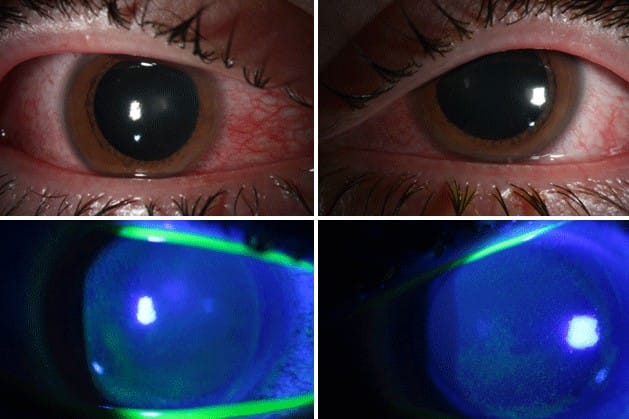 Covid collateral – UV lamp eye damage