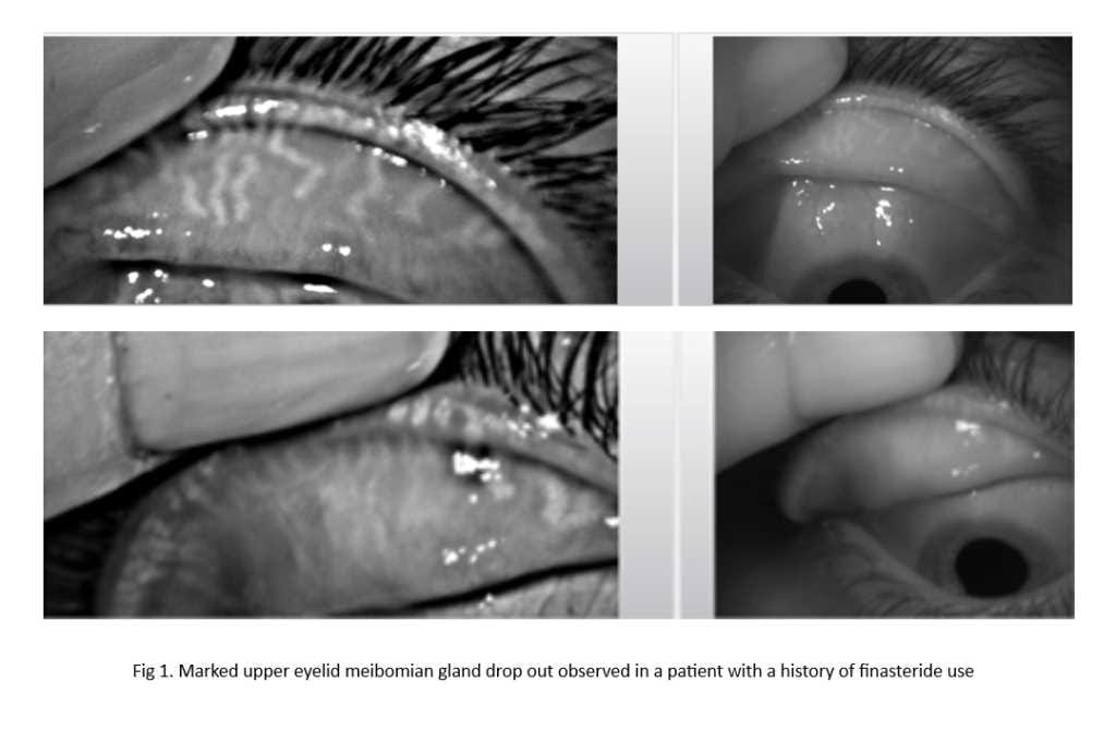 Finasteride and dry eye disease