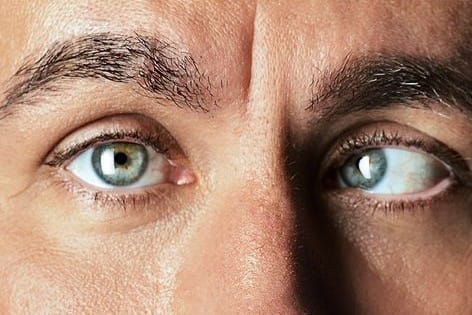 Calling strabismus patients!