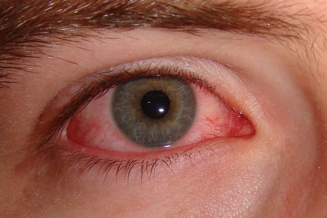 Promising conjunctivitis treatment
