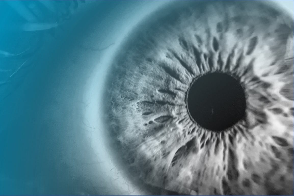 Glaucoma ocular implant clears phase I hurdle