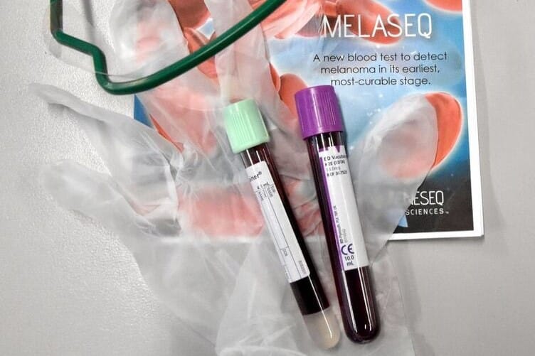Melanoma blood test a step closer