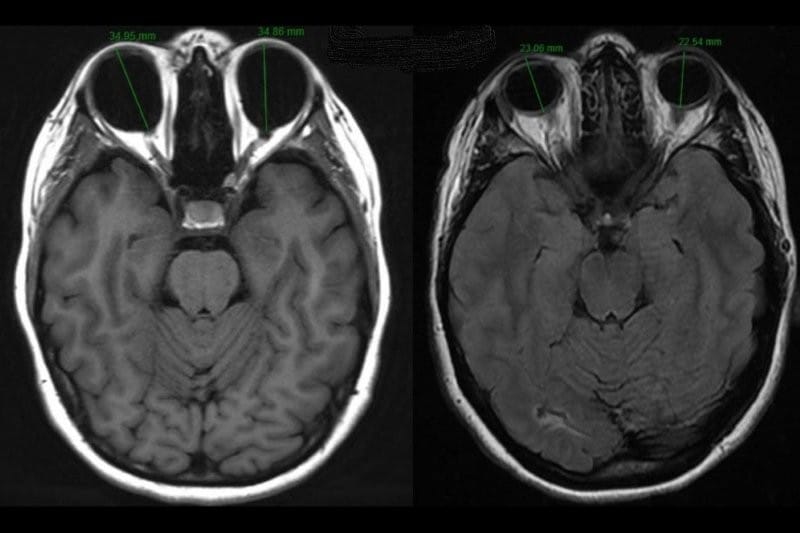 Pathological myopia
