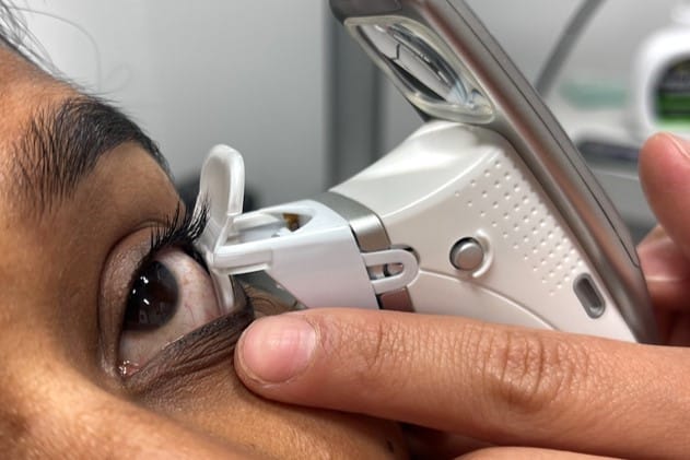 Handheld thermal pulsation device for MGD treatment
