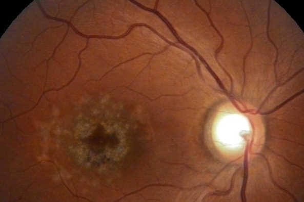 Promising Stargardt treatment (1)