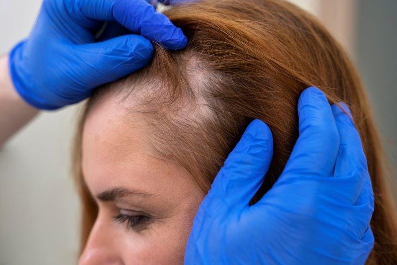 woman hair loss small