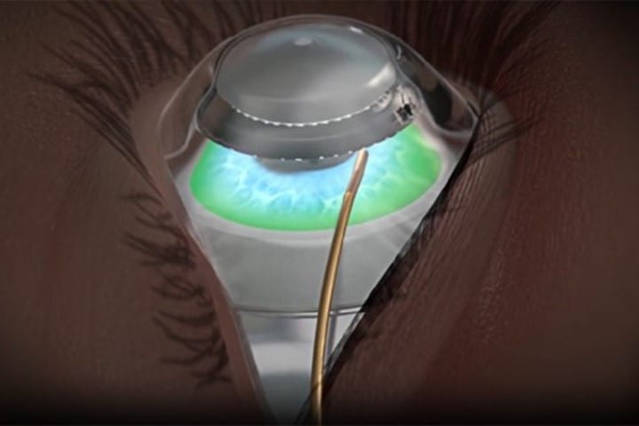J&amp;J boosts non-invasive refractive tech
