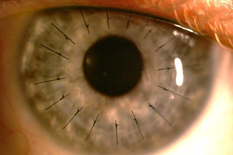 Corneal donation and corneal transplantation in Aotearoa