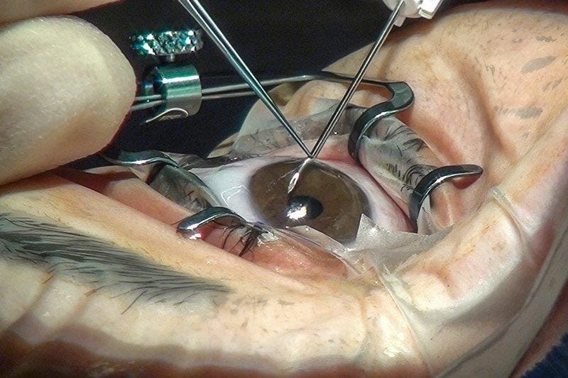 Long-term efficacy and safety of MIGS in glaucoma management (1)