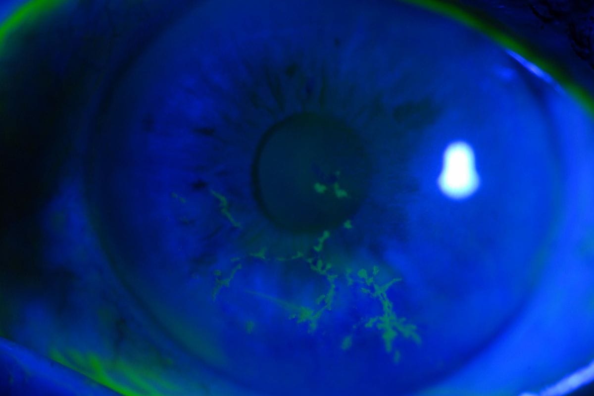 HZO-related disease post-cataract