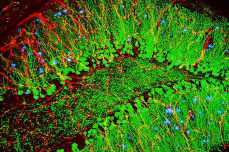 New eye test for Alzheimer’s