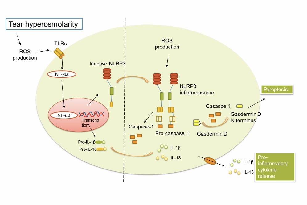 NLRP3 inflammasome as a key marker for DED severity
