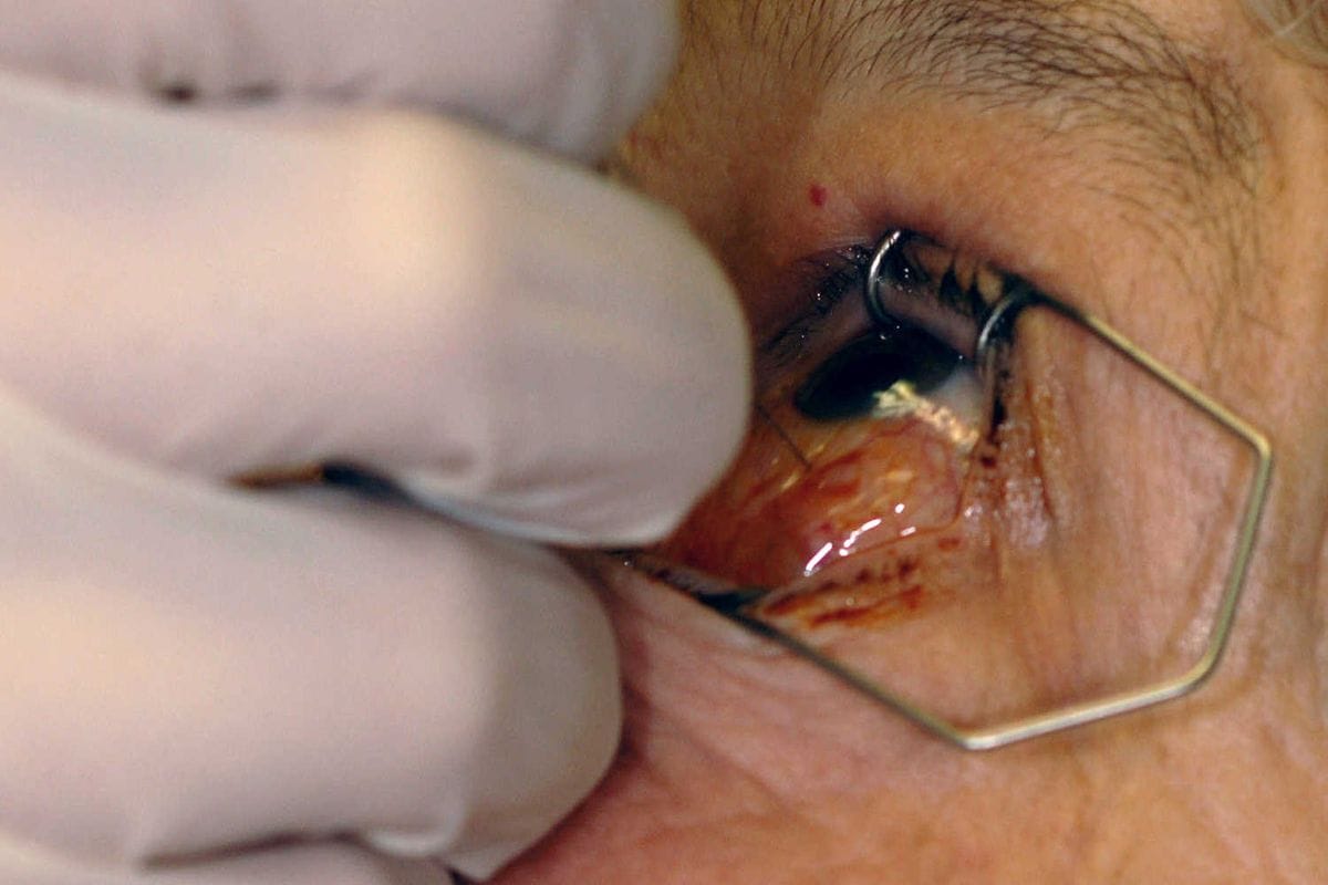 Cold as ocular anaesthetic alternative