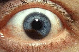 ‘Eye-saving’ oral UM treatment
