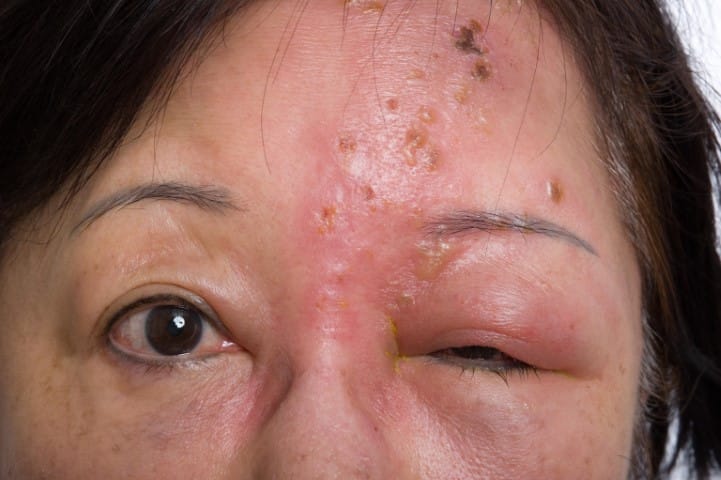 Shingles: a crucial conversation for the over-50s