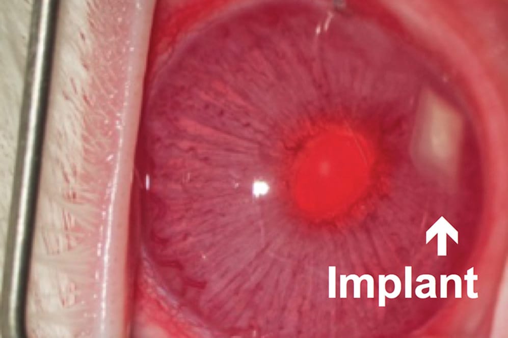Drug implant treats glaucoma