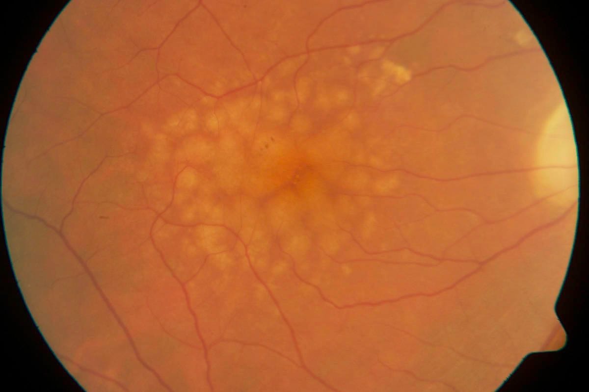 Insight into early AMD