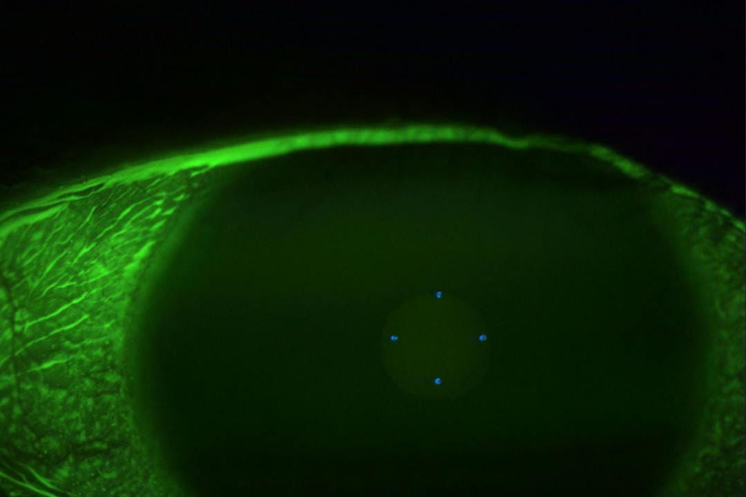 Finding relief with scleral lenses