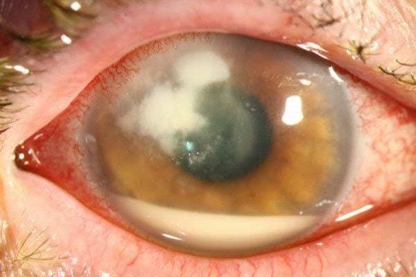 Keratoconus, Fusarium keratitis and bilateral cataract surgery
