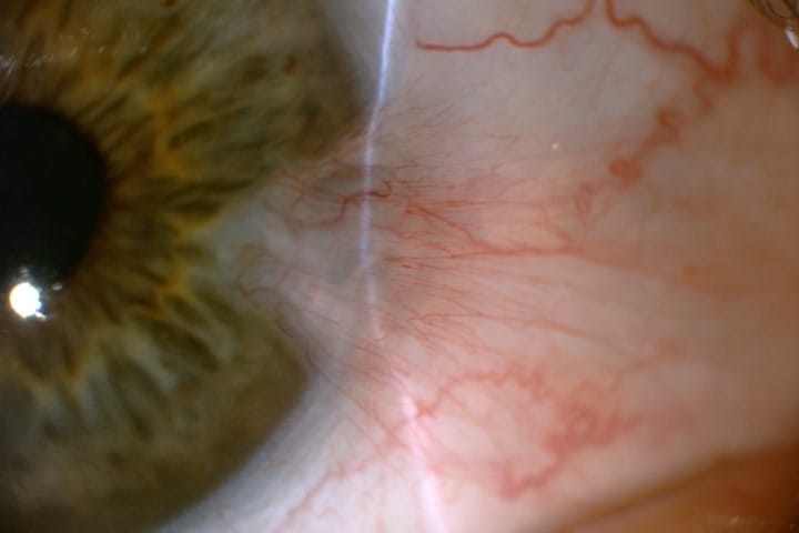 It’s just a pterygium… or is it?