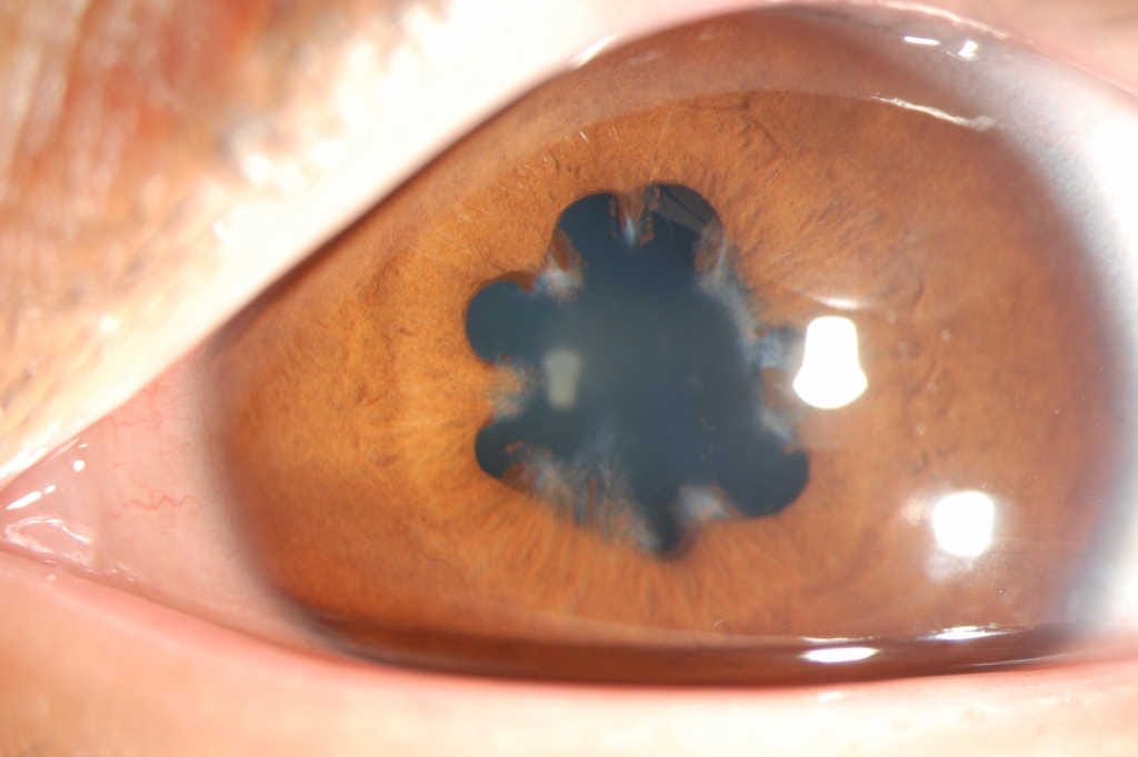 Adverse effects of cancer therapy on the ocular surface and anterior segment