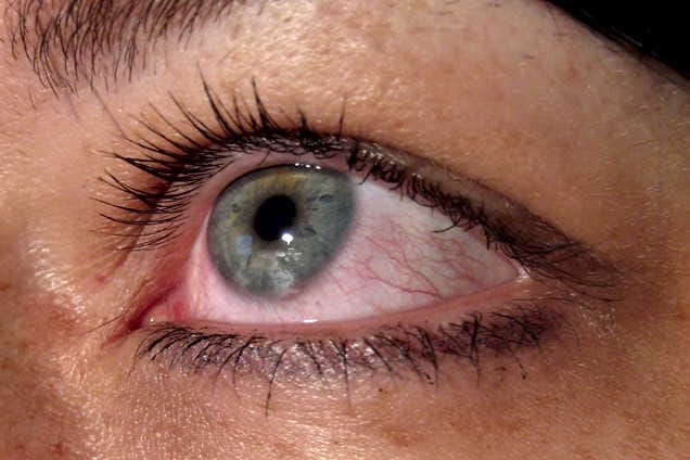 New anti-allergy CLs